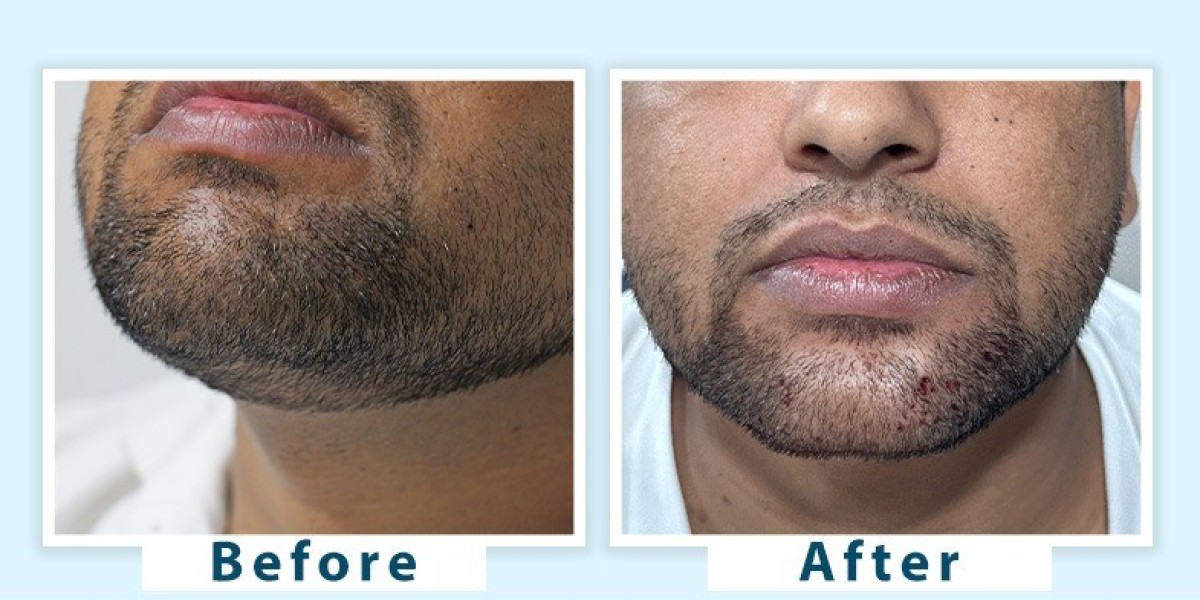 Expert Grey Beard Treatment in Delhi Best Doctors and Clinics