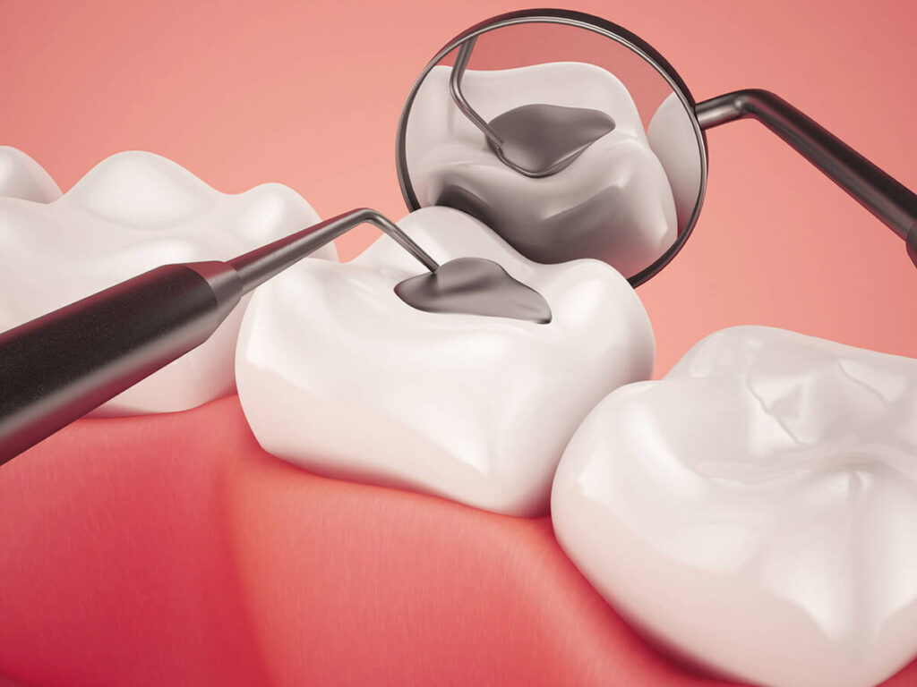 A Comprehensive Guide to Tooth Fillings in Overland Park, KS – Site Title