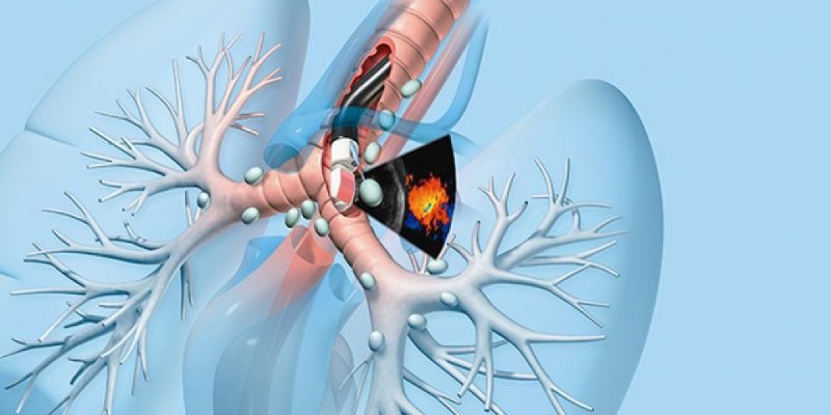 Endobronchial Ultrasound Biopsy A New Standard for Lung Cancer Diagnosis