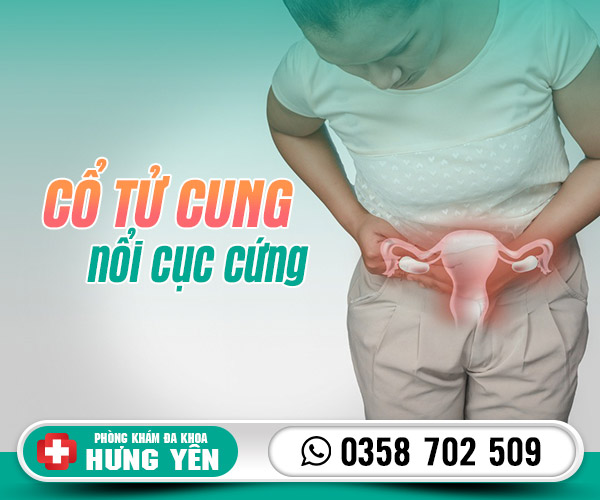 Cổ tử cung nổi cục cứng bị làm sao? - Phòng khám đa khoa Hưng Yên