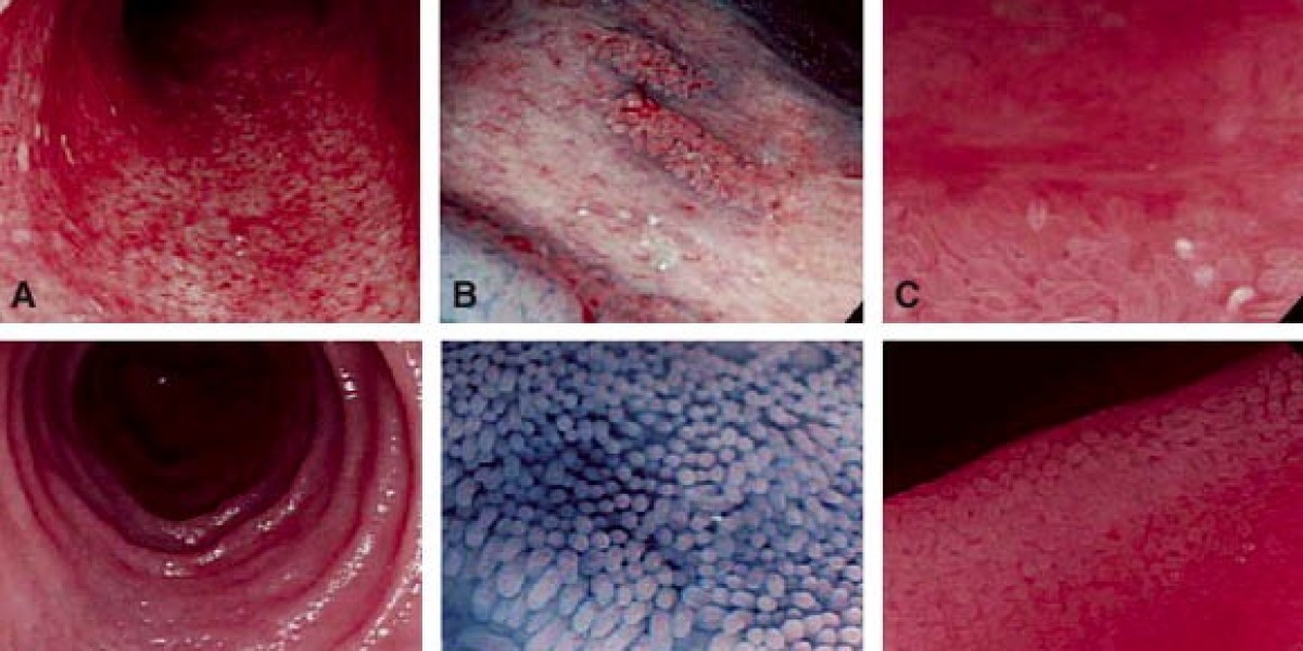 Acute Graft-versus-Host Disease Market to witness Significant expansion owing to Increasing Cancer Prevalence