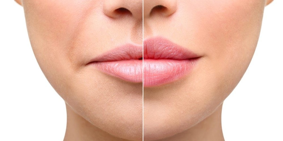 Everything You Need to Know About Dermal Fillers: Your Key to Timeless Beauty