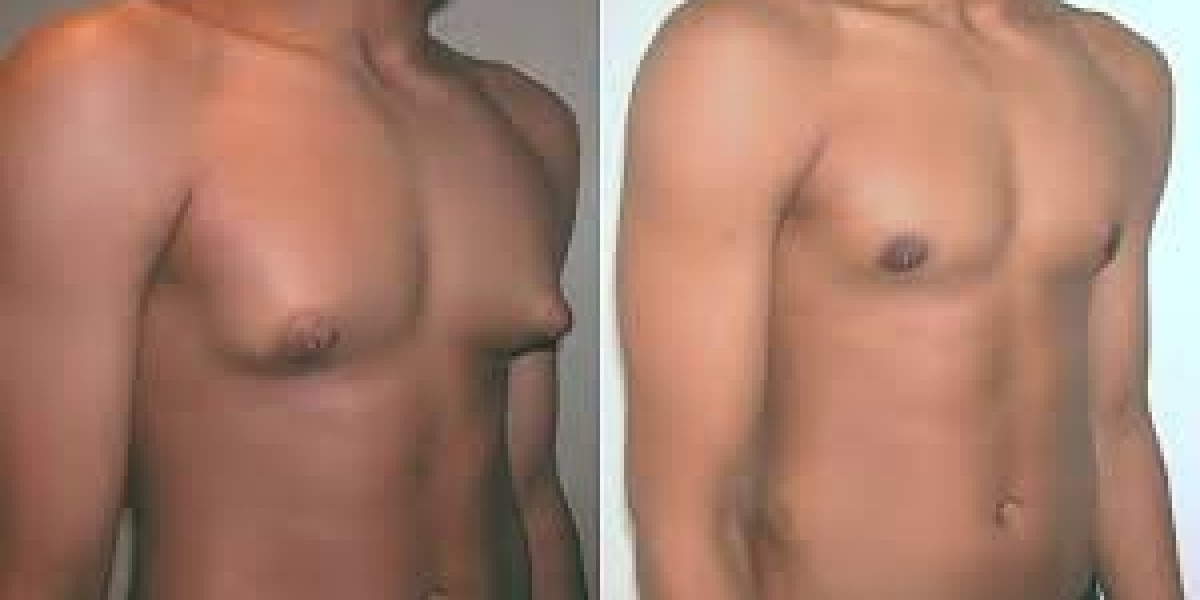 Gynecomastia Surgery Cost in Pakistan: A Complete Guide