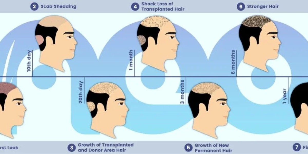 Hair Replacement Surgery in Turkey: A Leading Solution for Hair Restoration