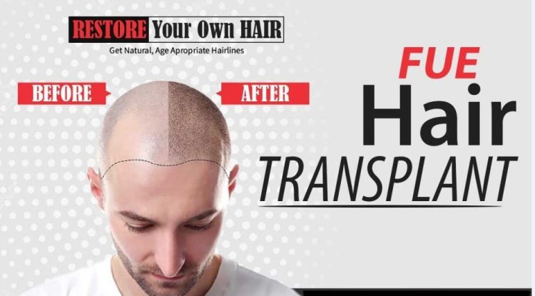 Why Is It Worth Going to Pakistan for Hair Transplant? - Los Angeles Newswire