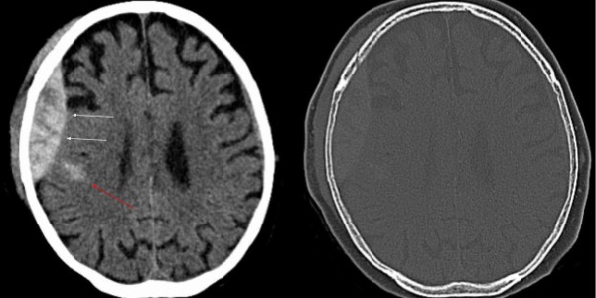 Challenges in the Intracranial Hemorrhage Diagnosis Market