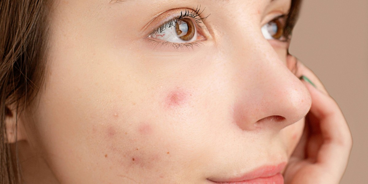 Acne Explained: Root Causes and Proven Solutions