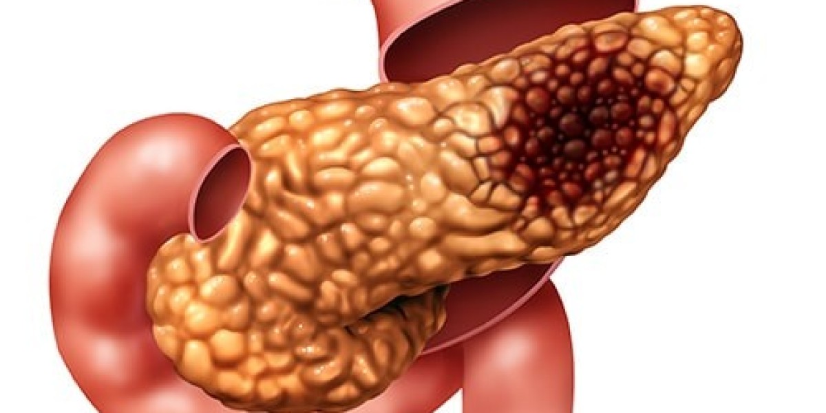 "Pancreatic Cancer: Early Detection, Treatment, and Life-Saving Solutions Online"