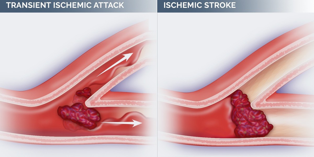 The Growing Demand for TIA Treatment Market: Market Trends and Future Opportunities