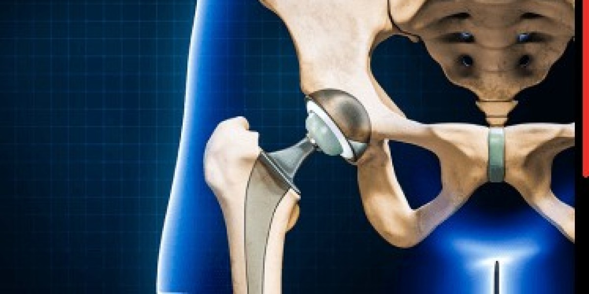 Lifetime Precautions after Hip Replacement