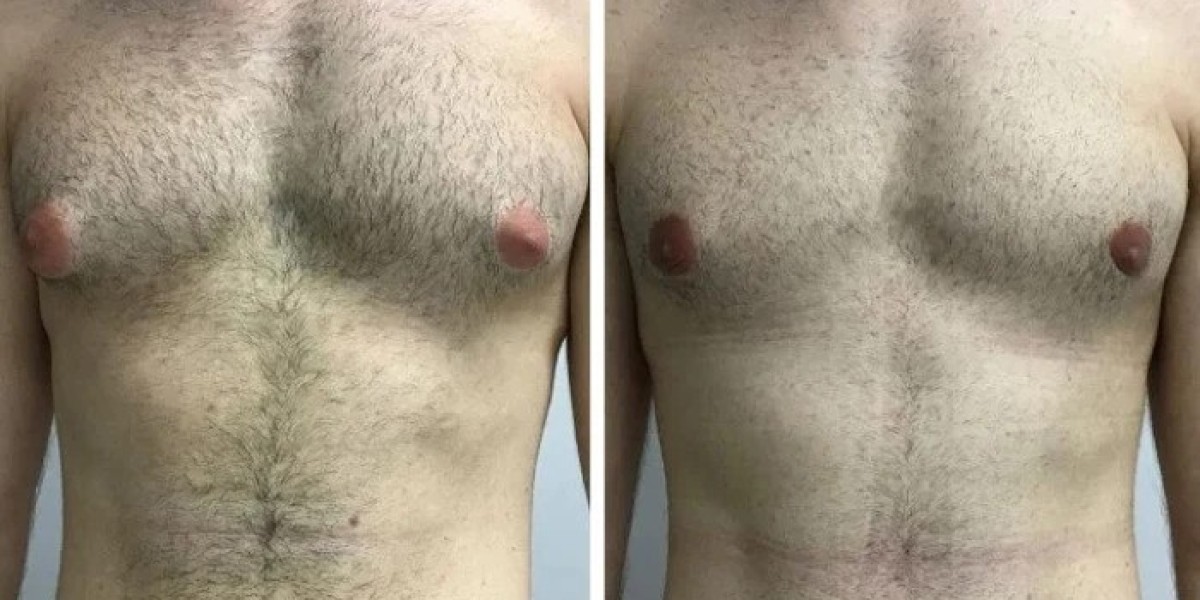 Gynecomastia Surgery in Dubai vs. Other Countries: Pros and Cons