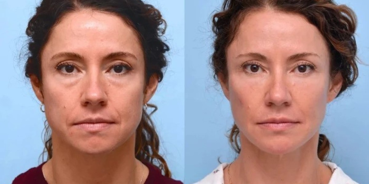Thread Lift in Dubai: How to Prepare for Your Appointment