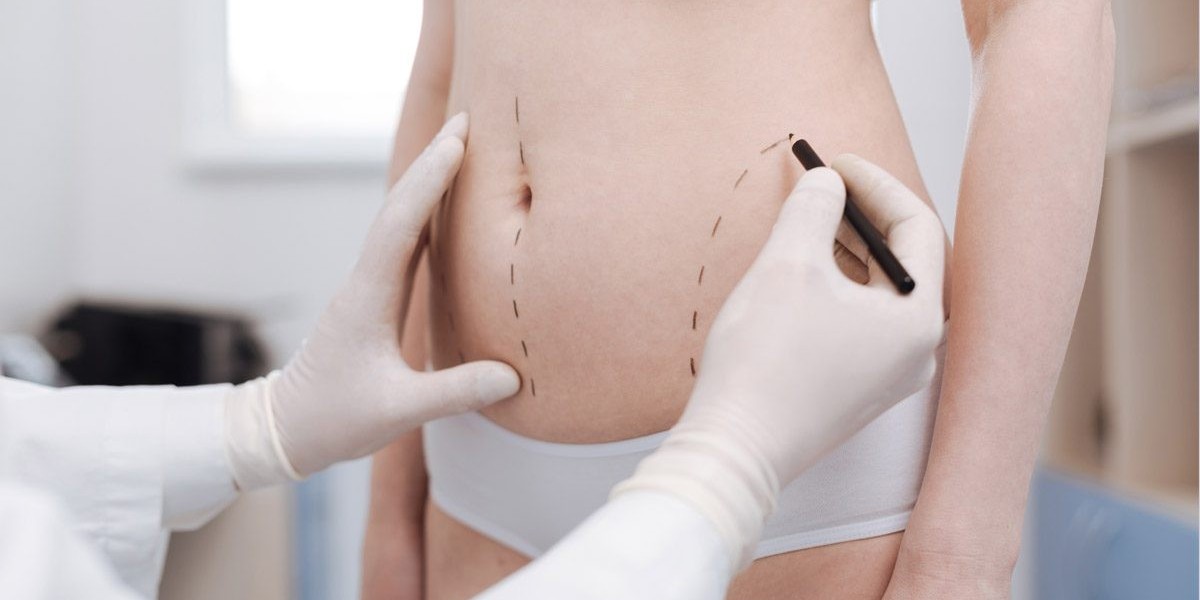 Is Liposuction Safe? What Every Patient Should Know