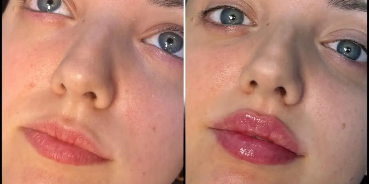 Best Doctors in Dubai for Fillers Injections for Natural-Looking Results