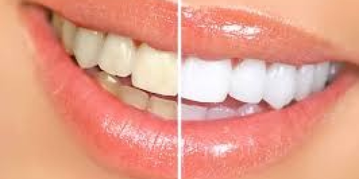 Dr. Imran Dental Care: Your Trusted Destination for Teeth Whitening in Lahore