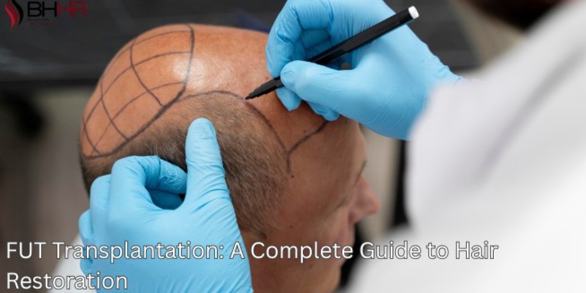 FUT Transplantation: A Complete Guide to Hair Restoration