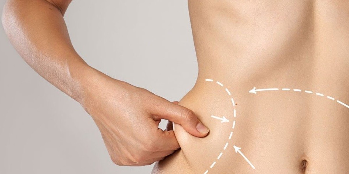 Understanding Risks and Side Effects of Liposuction in Islamabad