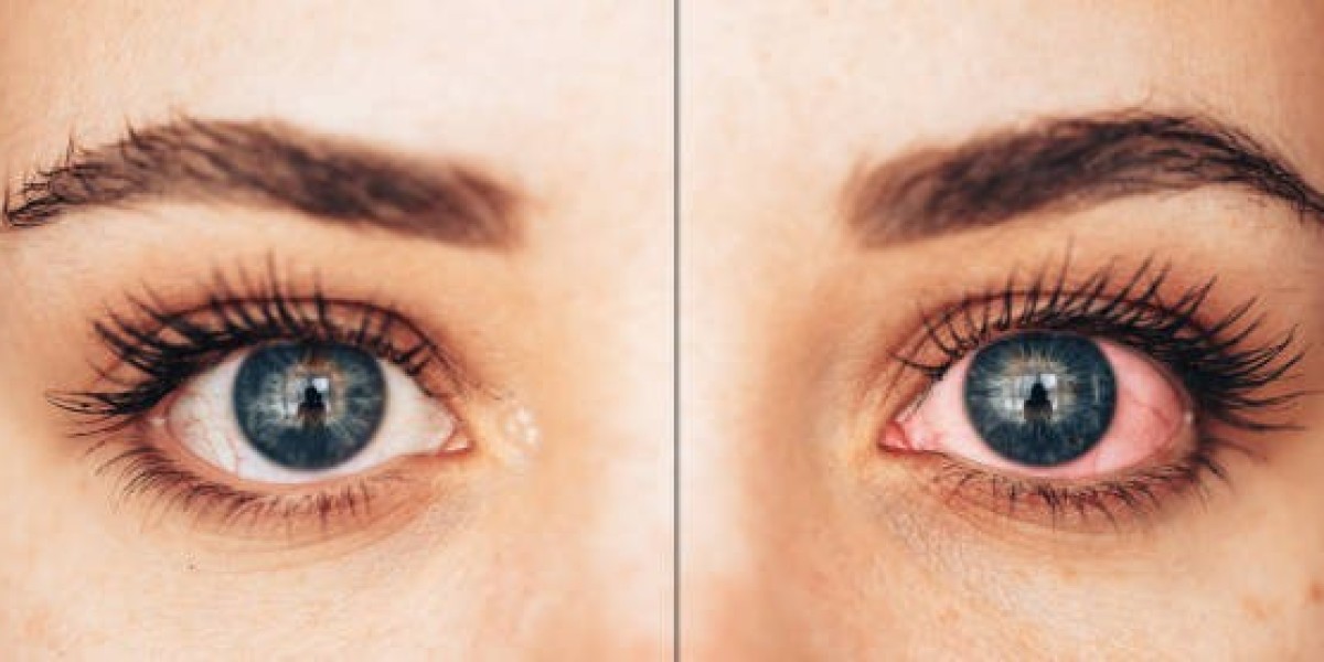 Eyelid Surgery for Tired-Looking Eyes: What You Need to Know