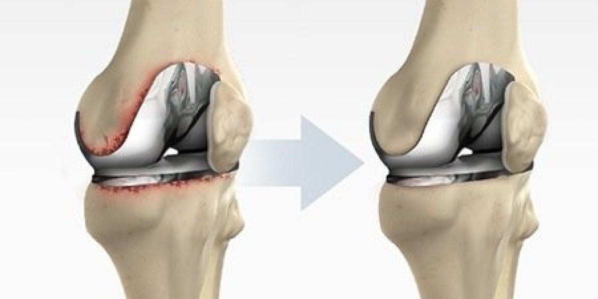 Top Qualities to Look for in the Best Knee Replacement Doctor in Jaipur