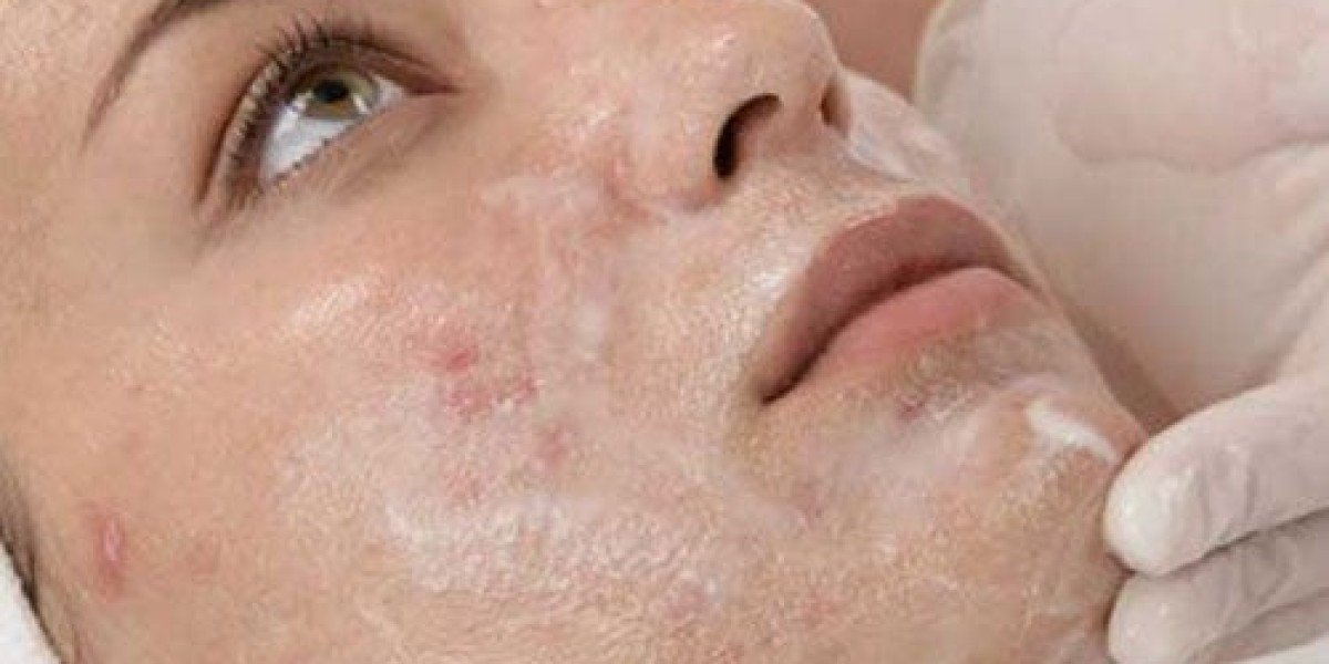 How Safe Is Chemical Peeling for Sensitive Skin?