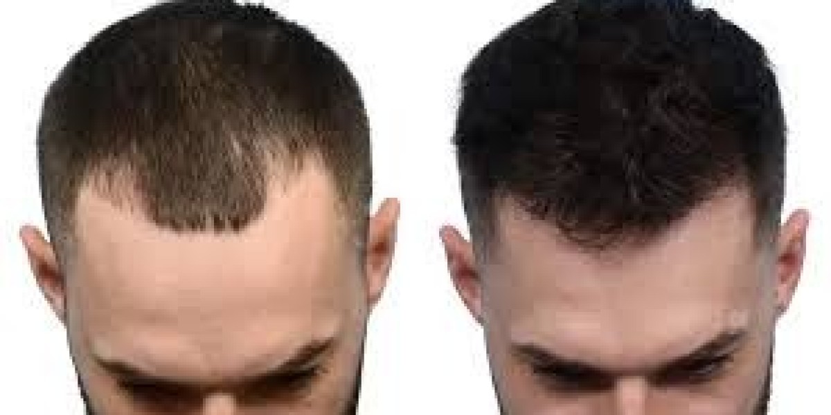 The Science Behind Non-Surgical Hair Systems: Dubai Explained In Dubai UAE At Glamorous Clinic