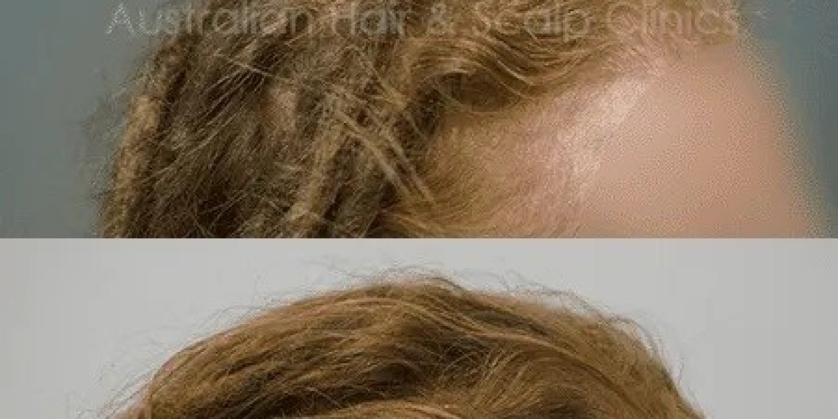 Hair Loss Treatment in Brisbane That offer Healthier Hair