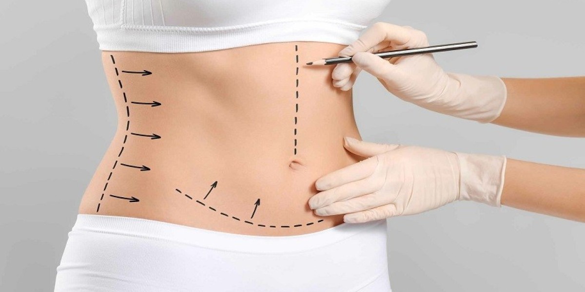 Liposuction Before and After Results You’ll Love