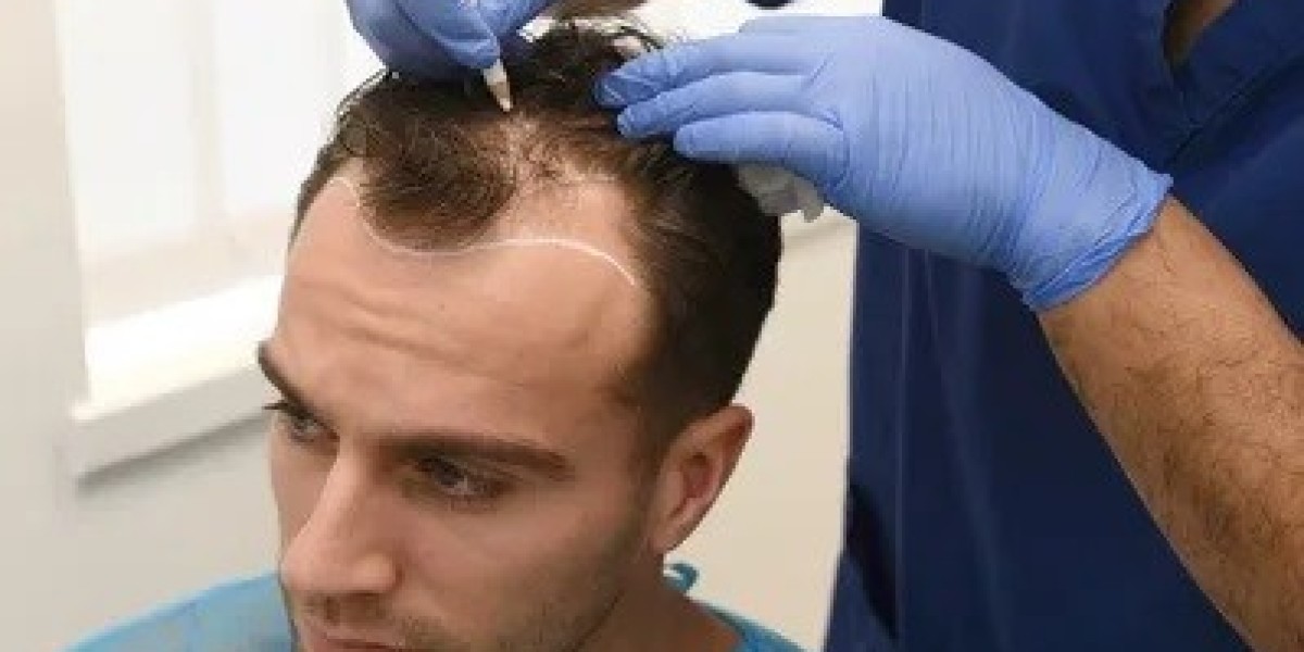Hair Transplant in Islamabad: Techniques for Thicker Hair