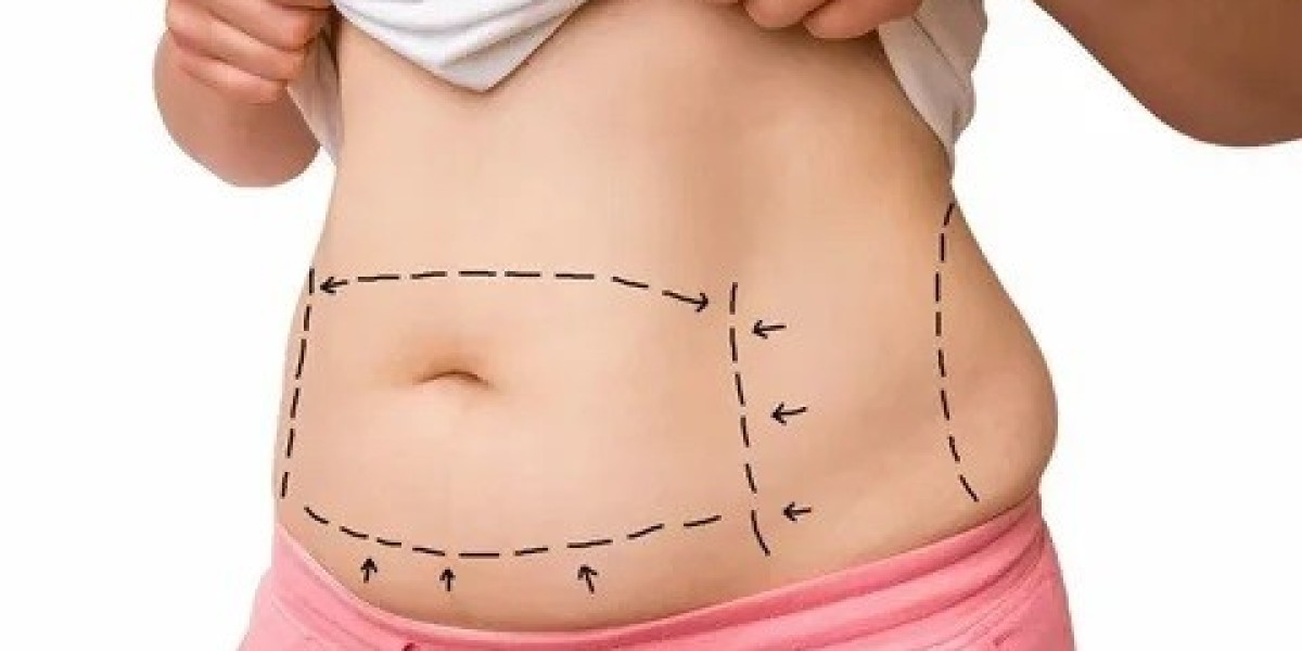 How to Sleep Comfortably After Circumferential Abdominoplasty in Islamabad