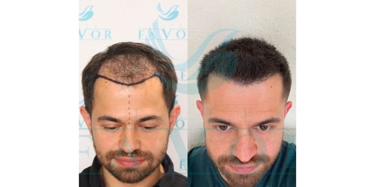 FUE, DHI oder Sapphire: Techniken im Haartransplantationszentrum Türkei