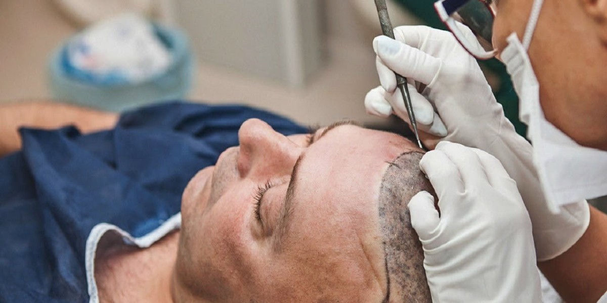 How to Choose the Best Hairline Design for You