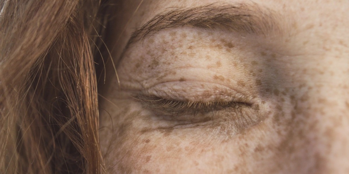 How to Maintain Results After Dermal Pigmentation Treatment?