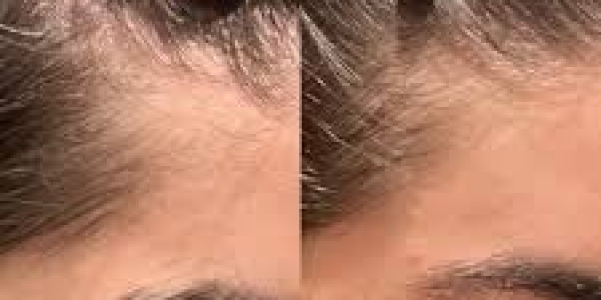 Hair Replacement Systems for Balding Men in Dubai UAE At Glamorous Clinic ?