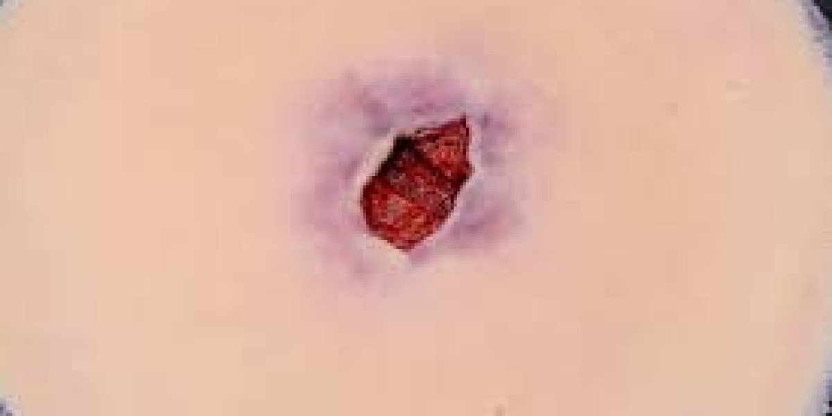 Tunneling Wound: Causes, Diagnosis, and Modern Treatment Approaches