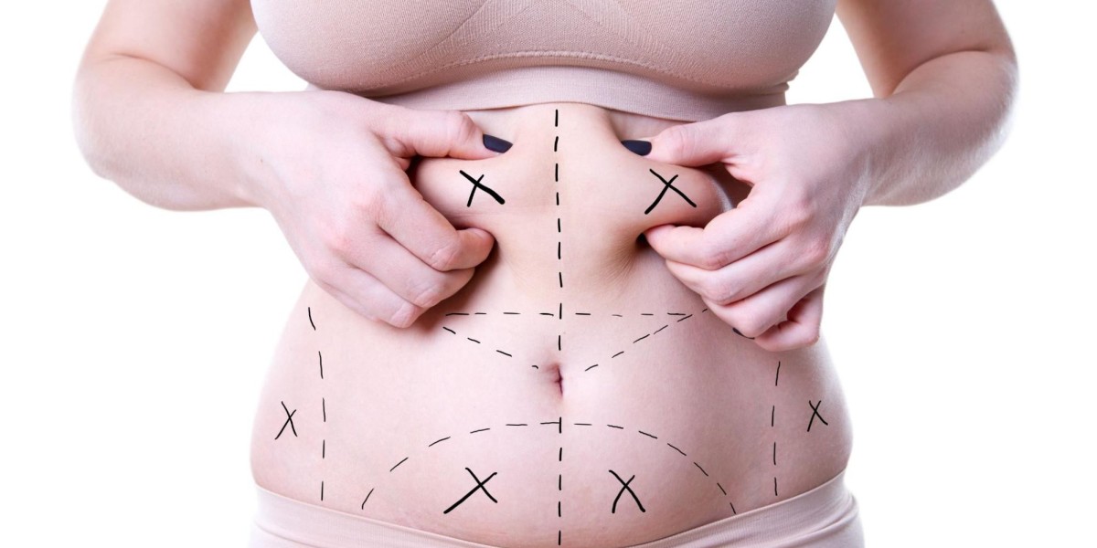 Can Liposuction Treat Gynecomastia in Men?