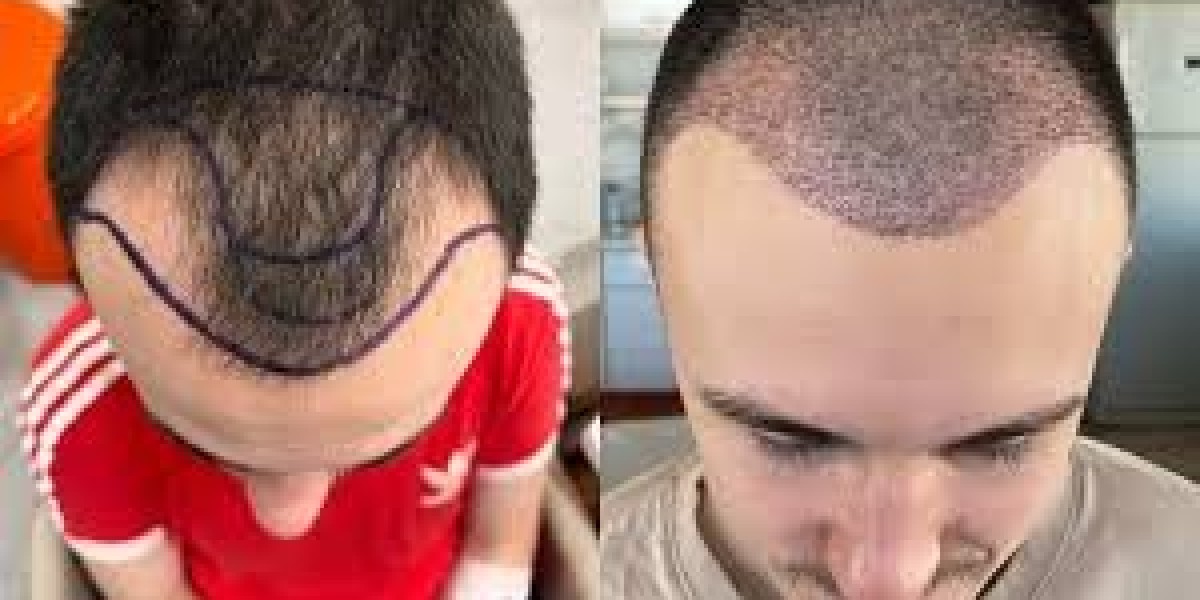 Visiting Dubai for Hair Transplant? Read This First!