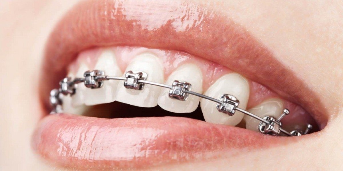 How to Handle Emergencies with Your Braces