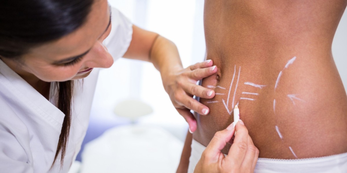 What’s the Difference Between Liposuction and Abdominoplasty?
