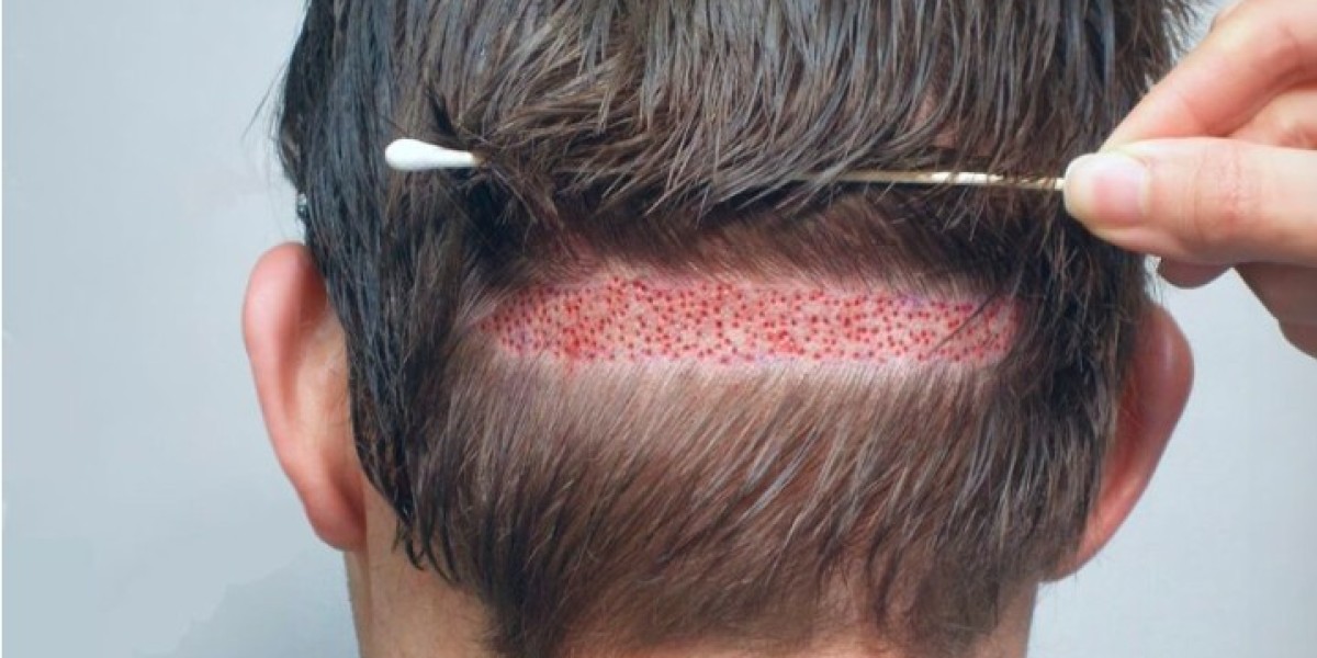 Why Hair Transplant in Pakistan is Popular Among Young Men