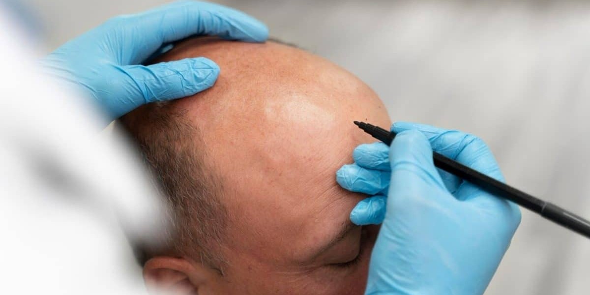 Why Do Some Hair Transplants Fail?