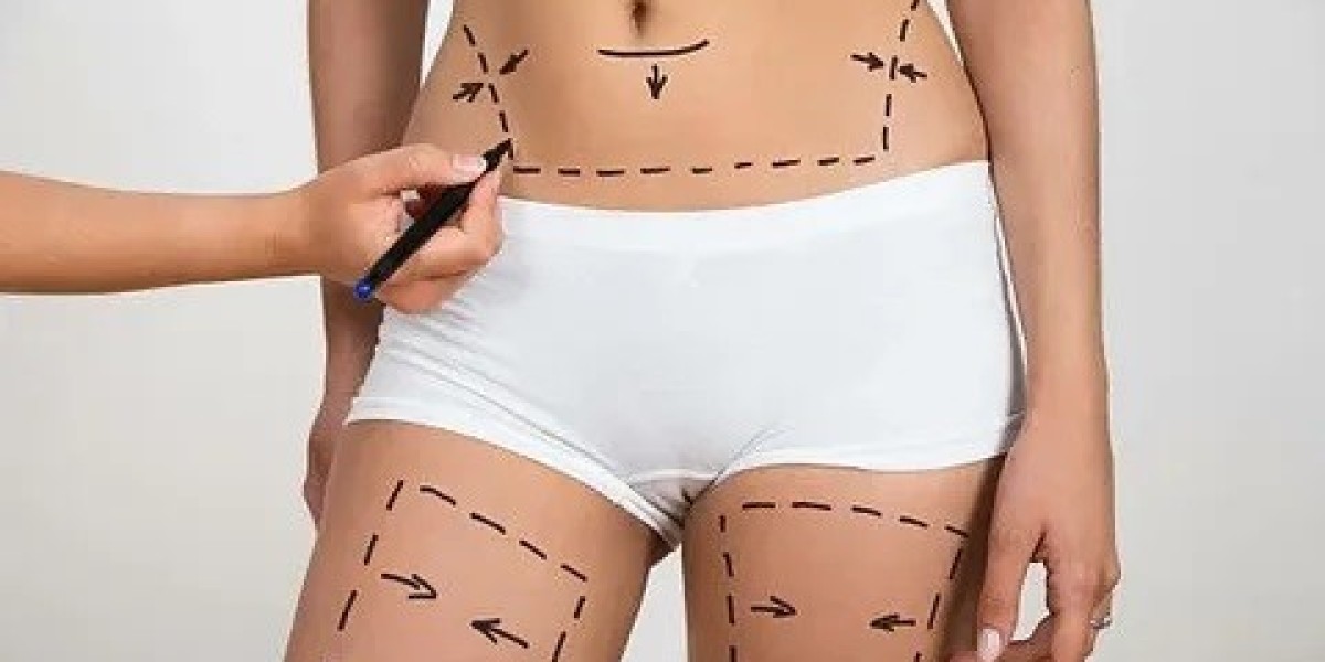 Liposuction vs. Non-Surgical Fat Removal: Which is Better?