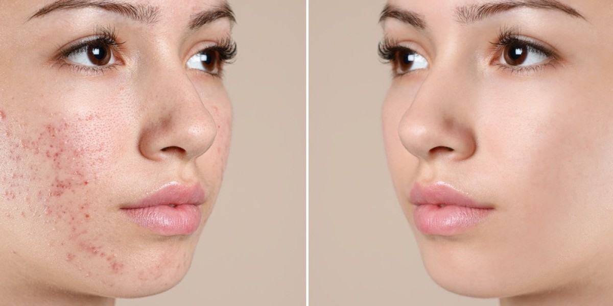 Effective Acne Treatment Facial Near Me: Complete Guide & Benefits