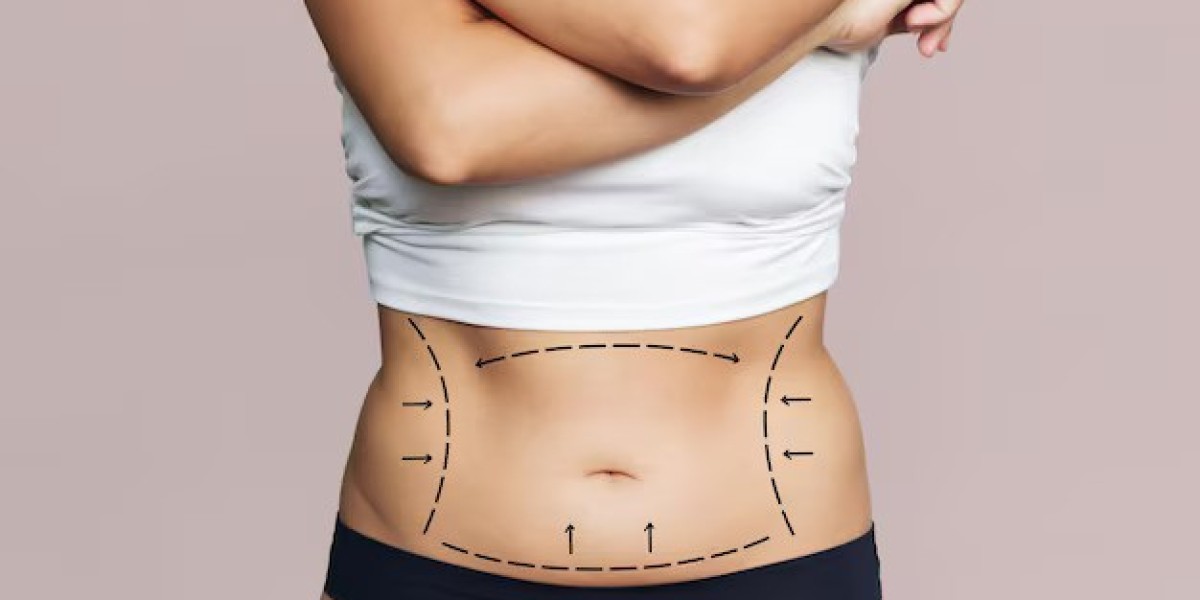 Complete Guide to Liposuction in Islamabad: Costs, Procedure & Recovery