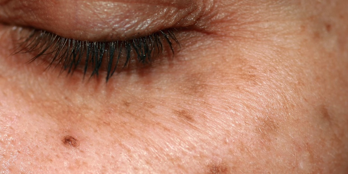 How to Even Out Skin Tone with Freckles and Blemishes?