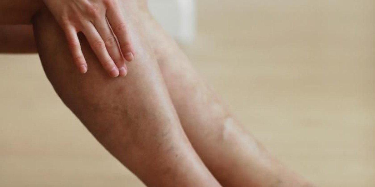 Varicose Veins Treatment Options for Mild to Severe Cases