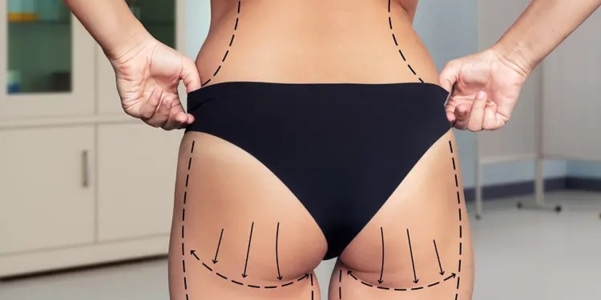 Experience Subtle, Beautiful Enhancements Through Butt & Body Fillers Today