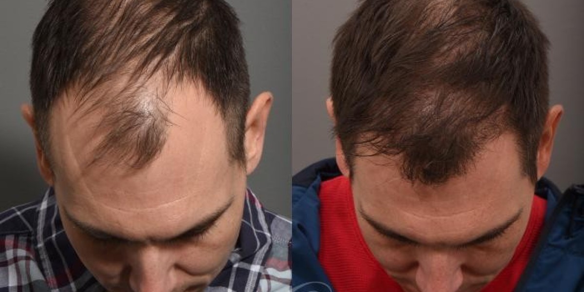 Finasteride 1mg Price: How to Plan Your Monthly Budget