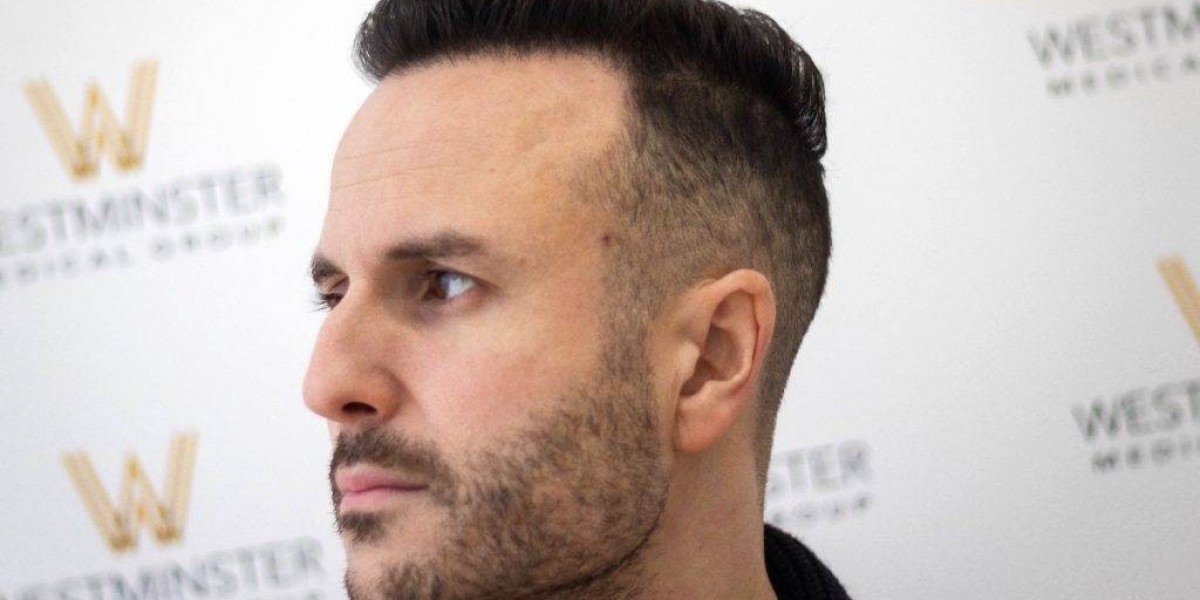 How Hair Transplant London Helps You Regain Confidence and Natural Hair