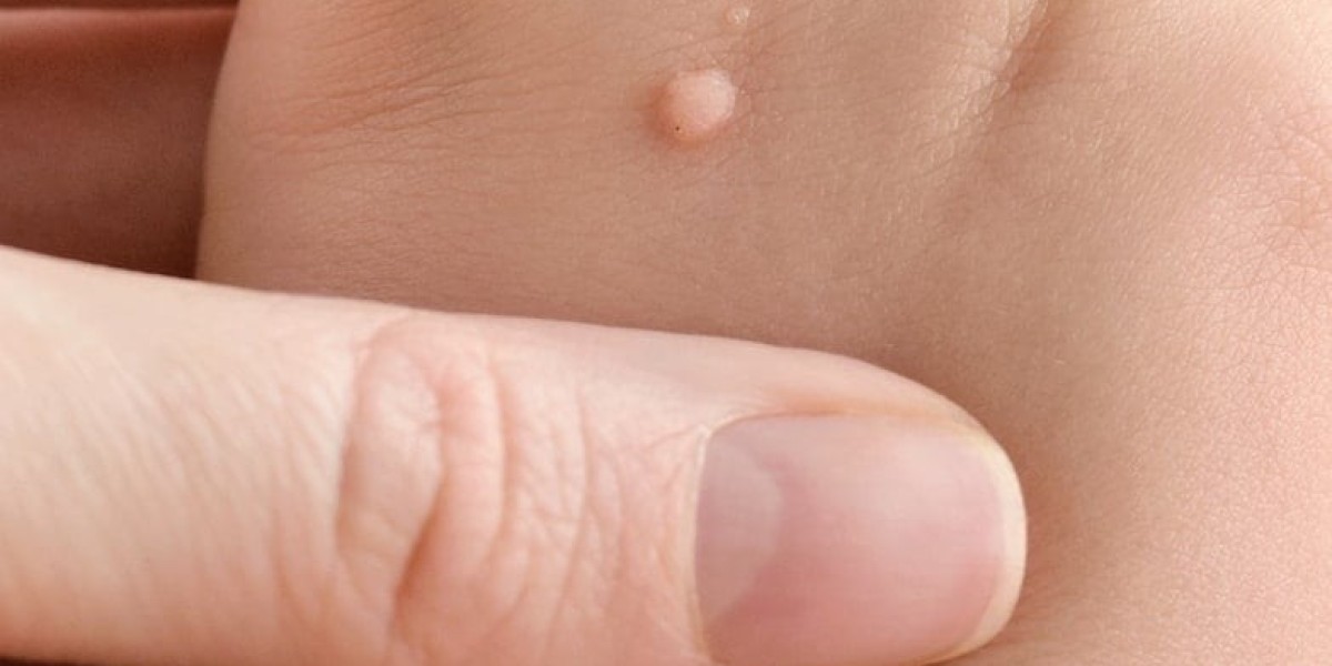 Achieving Smooth and Clear Skin Through Professional Wart Treatments: