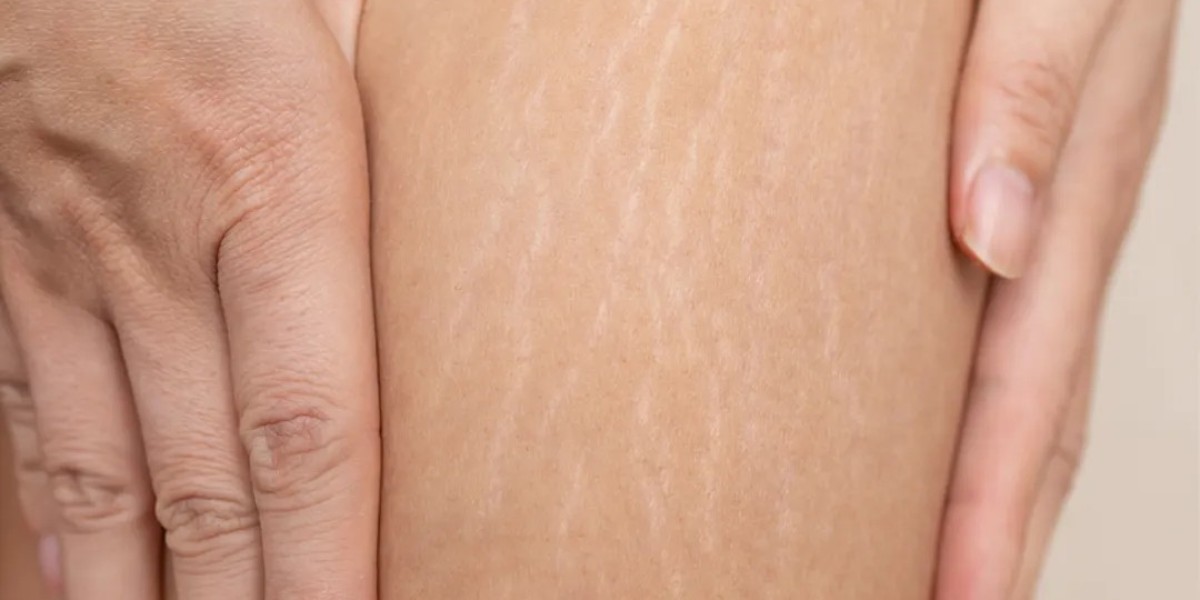 Is Stretch Mark Removal Painful?